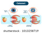 Cataract Vector Illustration...