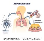 aspergillosis lung infection... | Shutterstock .eps vector #2057425133