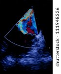 Small photo of Screen of echocardiography (ultrasound) machine. Total mitral insufficiency