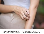 Small photo of Asian woman scratching her arm skin, concept of dry skin, allergic dermis inflammation, fungus infection, dermatology disease, eczema, rash, skin care