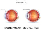 Cataracts And Healthy Eye...