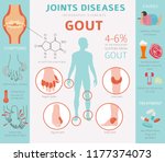 Joints Diseases. Gout Symptoms  ...