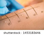 Immunologist Doing Skin Prick Allergy Test on a Woman’s Arm