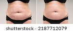 Small photo of Before and after removing stretch marks from the skin, fat flabby female belly on gray background, skin care concept