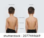 Small photo of Signs Of Scoliosis. Normal healthy spine and curved spine with scoliosis.Scoliosis in children