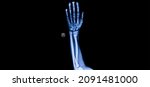 Small photo of A photo of plain radiograph on dark background in hospital. The film use for diagnosis the illness of patient.Medical concept. A children with fracture distal radius bone. A green stick fracture.