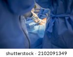 A close up image of surgeon's hand during endoscopy operation to remove gallstone with surgical laparoscopy instrument.Keyhole gallbladder surgery in cholecystitis with abdominal pain.Medical concept.