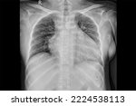 Small photo of Chest x-ray image demonstrated heart, lungs, ribs, bones and muscles.Metastatic cancer or primary tumor are differential diagnosis.Xray shown cardiomegaly in congestive heart failure woman patient.