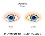 Jaundice. Comparison And...