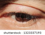 Small photo of close up Blepharitis or Eyelid inflammation healthy eyes concept