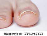 Small photo of Closeup of a minor case of Pincer Nail on young woman’s toe