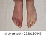 Small photo of Injured and swollen toes on a man's right foot compared to an uninjured left.