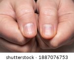 Small photo of Right and left hand showing ridged nails on thumbs. Caucasian woman, short cut nails.