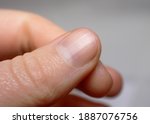 Small photo of Ridged fingernail of a thumb finger of a caucasian woman with vertical ridges. Very short cut nails.
